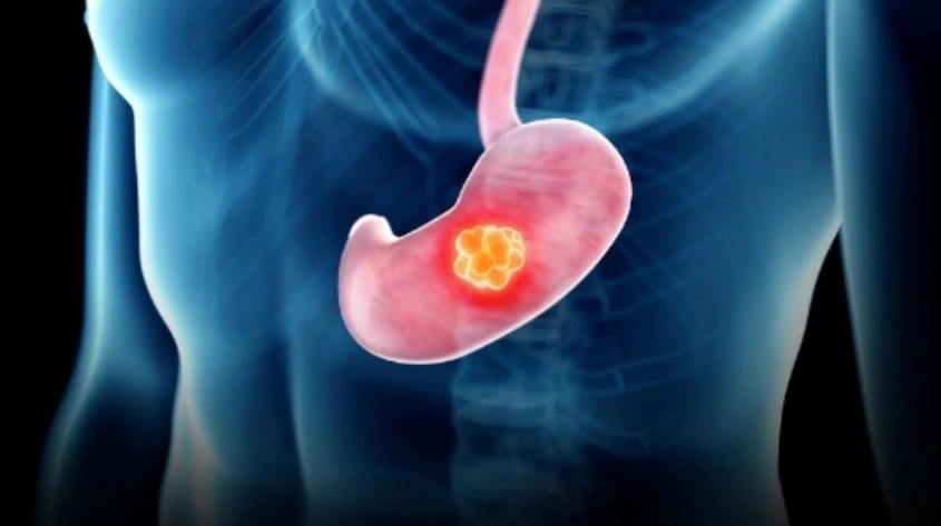 GI cancer screening in Kokapet