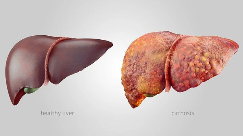 Cirrhosis and liver complication care