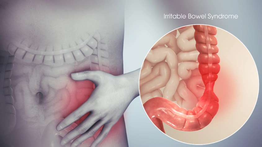 IBS treatment in Kokapet